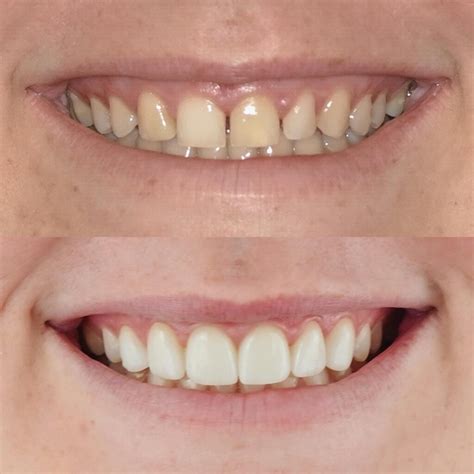 Dental Veneers: Benefits, Procedure, Costs, and Results.